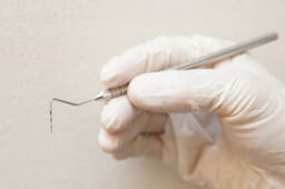 歯の裏側にワイヤーとブラケットを取り付ける「リンガル矯正」も人気